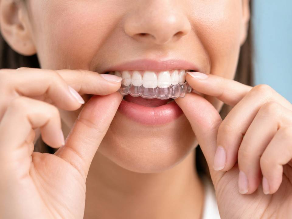 Primer plano de una mujer colocándose un alineador transparente sobre los dientes superiores.