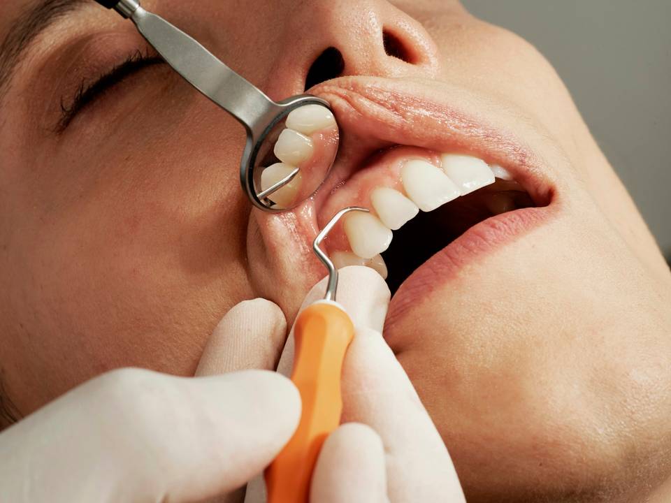 Primer plano de una exploración dental con espejo y sonda junto a los dientes de un paciente.